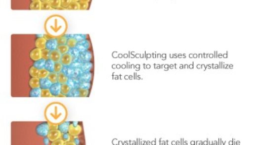 Chilling the Fat: Exploring the World of Cool Sculpting and Fat Freezing