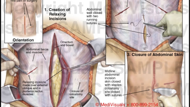 Flatten Your Tummy: The Ultimate Guide to Abdominoplasty