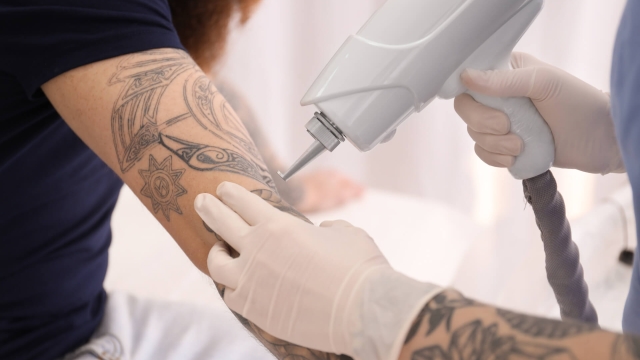 Selecting A Tattoo Removal Laser Clinic