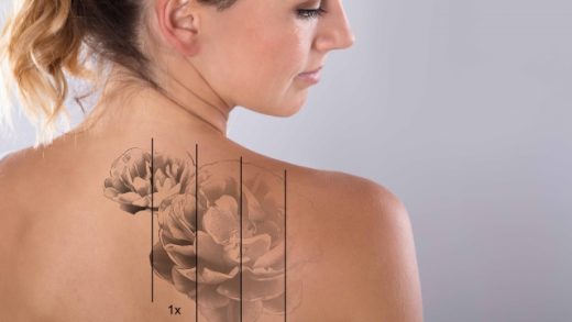 Tattoo Laser Removal – Hurts Like Heck – Is It Worth The Following?