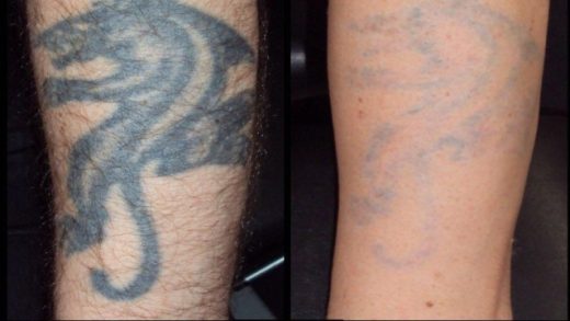 Tattoo Removal Procedure – Your Option For A Tattoo That Needs To Be Removed