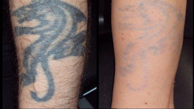 Tattoo Removal Procedure – Your Option For A Tattoo That Needs To Be Removed