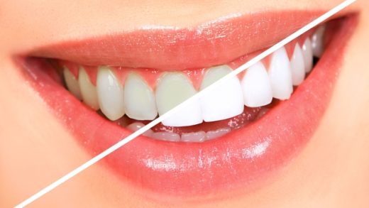 Beaming Bright: Unveiling the Secrets of Teeth Whitening