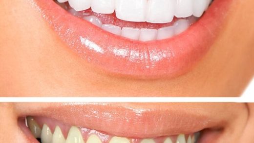 Get Your Smile Shine: Unveiling the Secrets of Teeth Whitening