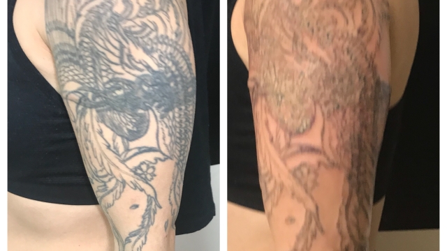 Tattoo Regret – Removing A Mistake