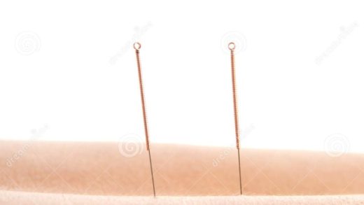 The Healing Power of Acupuncture: Needle Your Way to Wellness