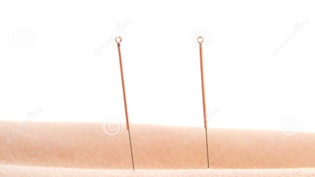 The Healing Power of Acupuncture: Needle Your Way to Wellness